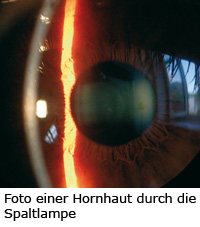 Foto einer Hornhaut durch die Spaltlampe, Praxis Nürnberg